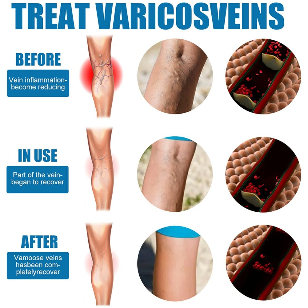 South Moon Varicose Veins Treatment Spray – 30ml